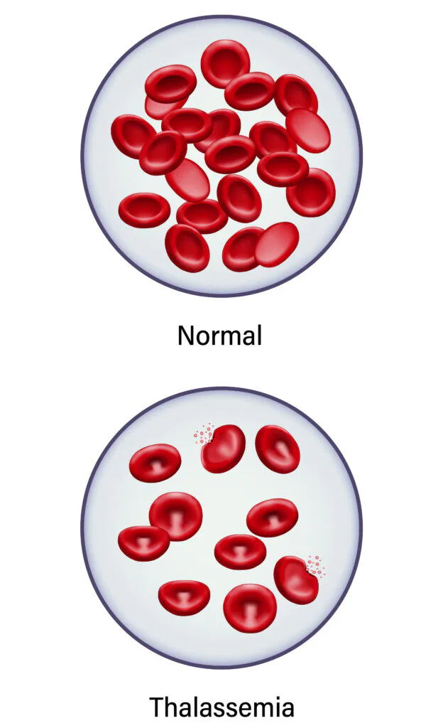 Imagem 7 de O que é talassemia?