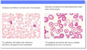 Imagem 4 de Os tipos de Talassemia